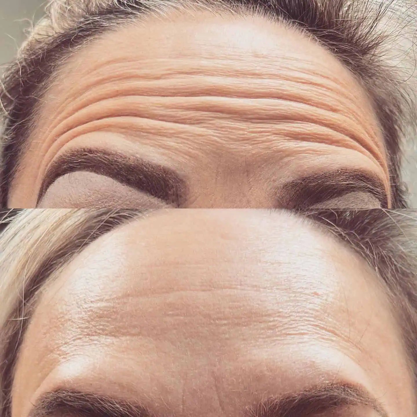 Dysport® Before and After a