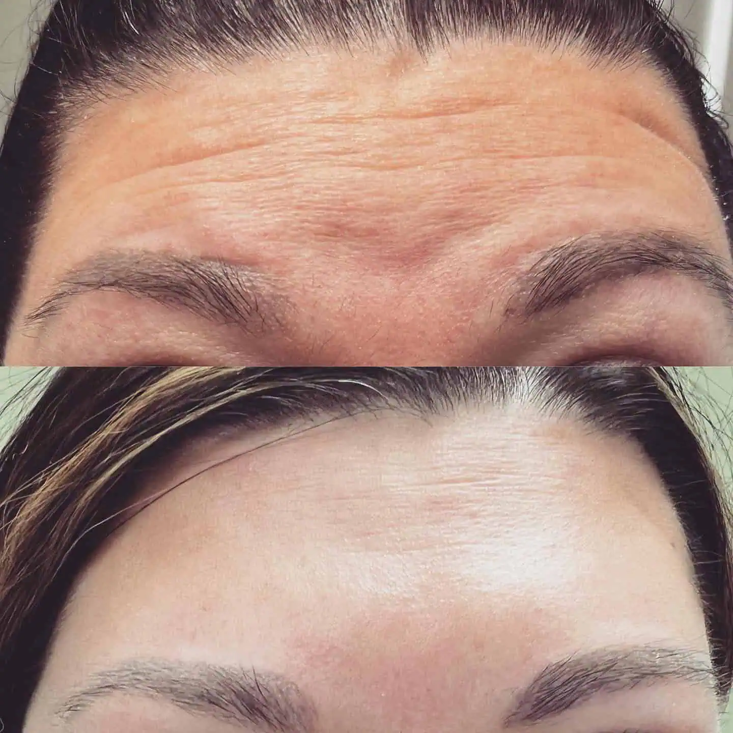 Dysport® Before and After b