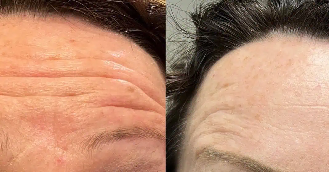 Dysport® In Derby, KS test 141364 4 Dysport® Before and After c