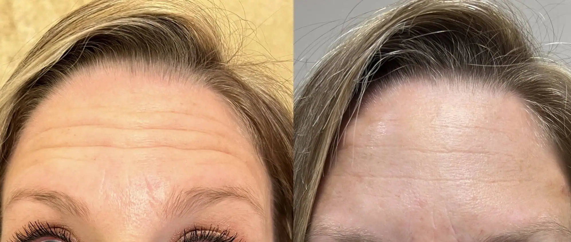 Dysport® In Derby, KS test 141364 5 Dysport® Before and After d