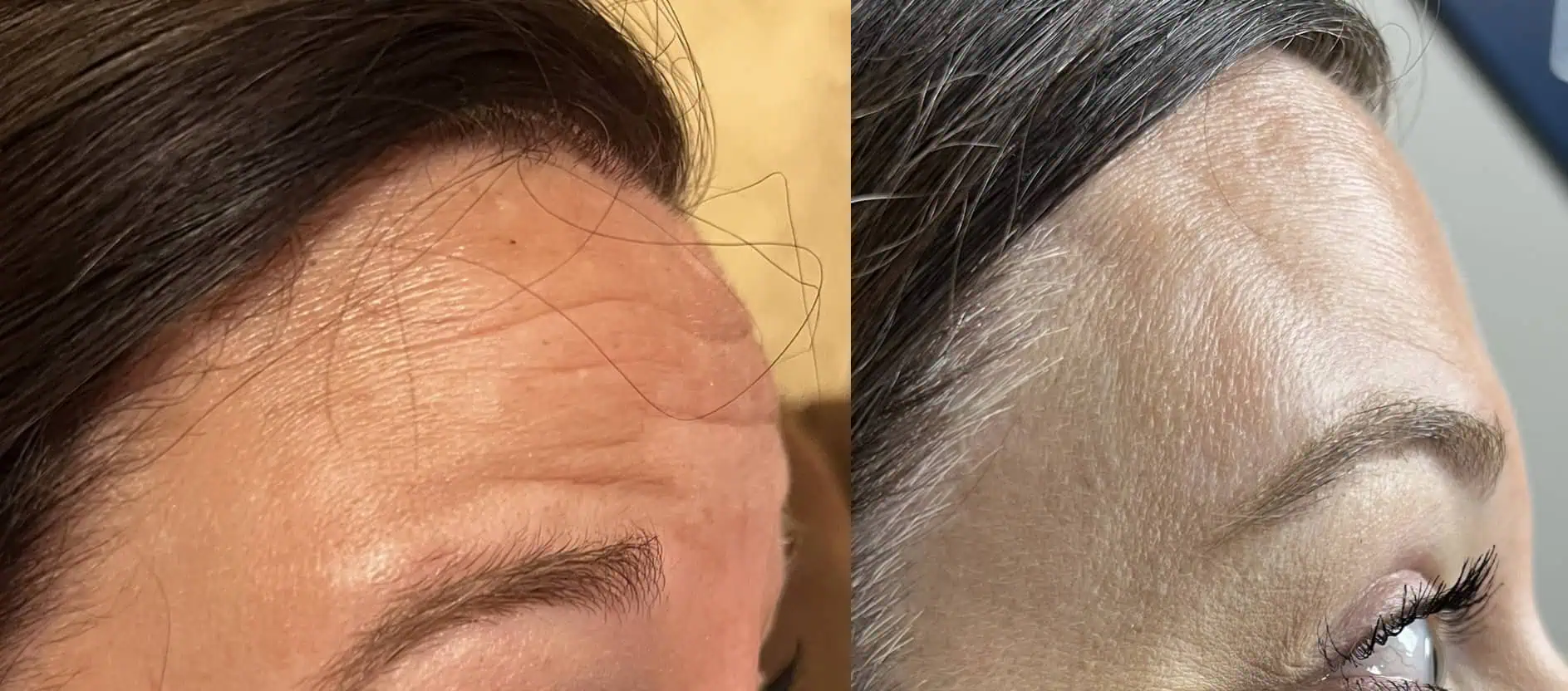 Dysport® In Derby, KS test 141364 6 Dysport® Before and After e