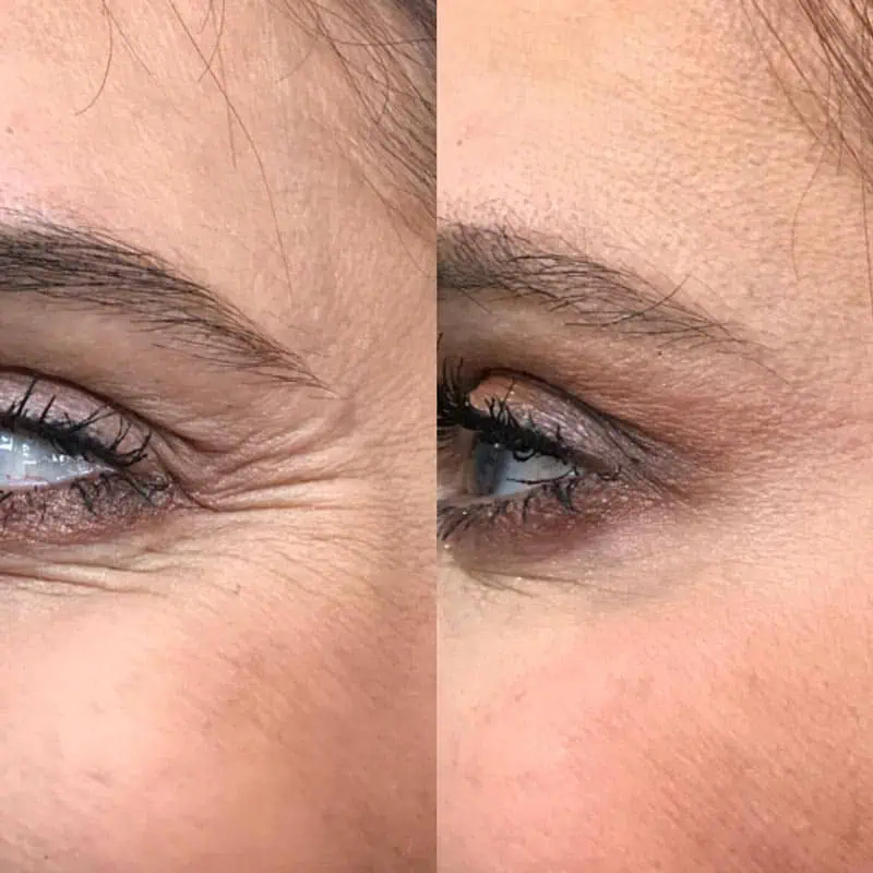 Dysport® In Derby, KS test 141364 1 crows feet before and after