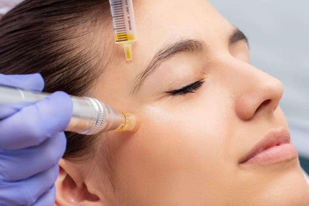 prpmicroneedling